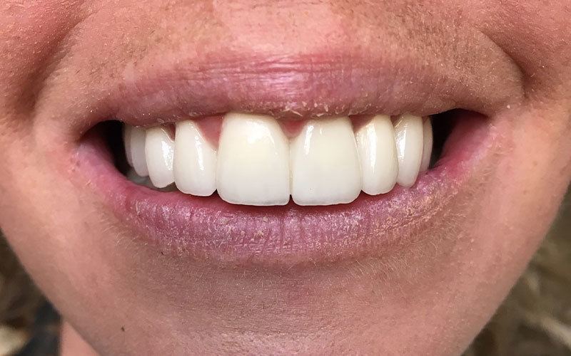 Six Month Smile Before and After
